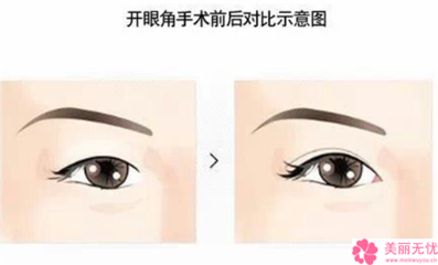 割双眼皮在哪里