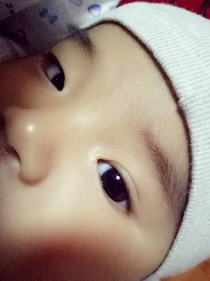 宝宝上眼皮红肿怎么办