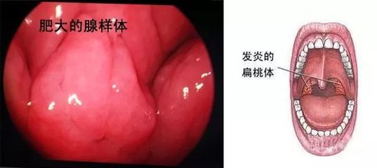 扁桃体一个月发炎三次