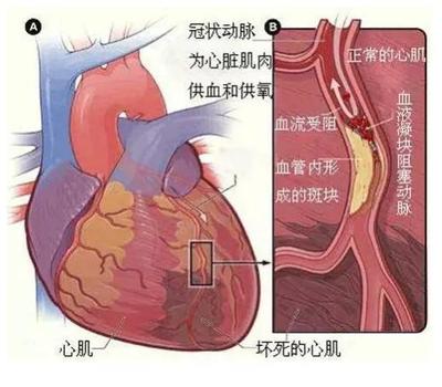 心机缺血是怎么回事