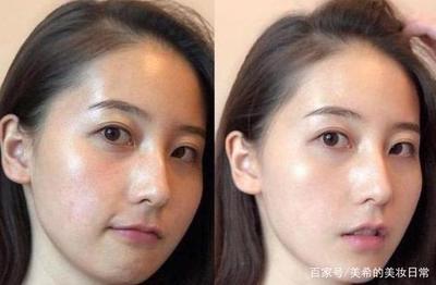 脸上长平滑的痘痘