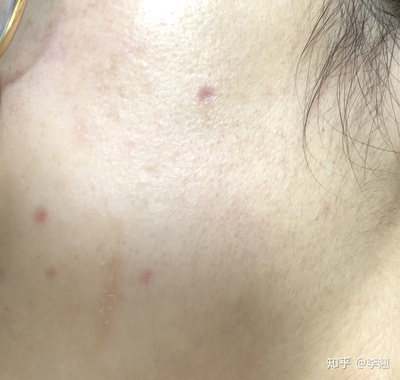 药水点痣后的恢复过程