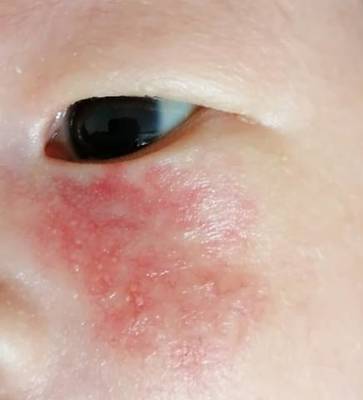 红奶白色痘痘