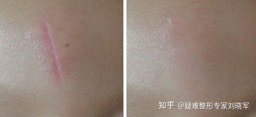 疤痕修复最佳时间