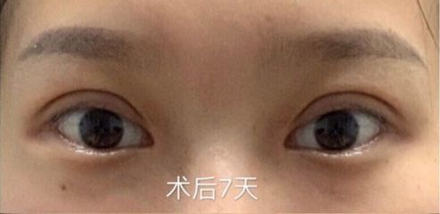 全切双眼皮忌口