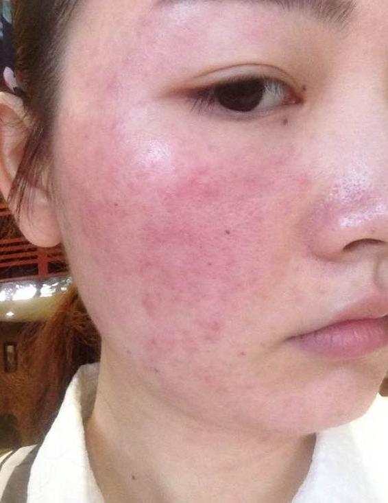 红血丝皮肤用什么面膜
