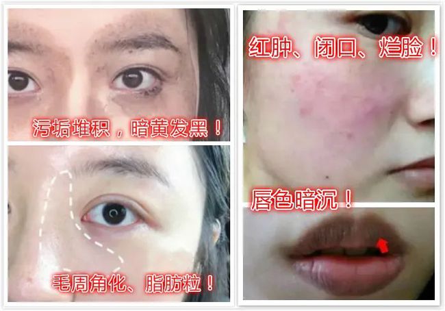 脸颊长闭口痘痘的原因分析