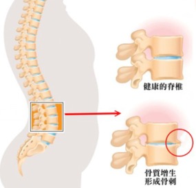 骨刺增生怎么治疗