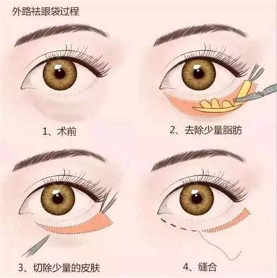 眼部脂肪填充