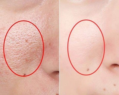 如何使毛孔变细腻