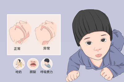 新生儿舌后坠