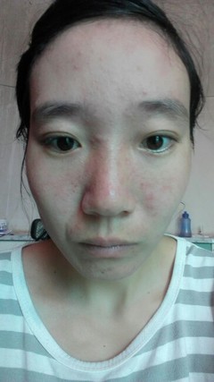 好多痘痘烦死了