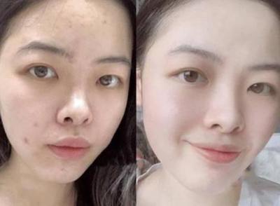 脸上有痘痘可以敷什么