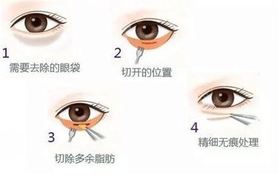眼袋大是怎么回事