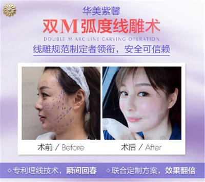 线雕除皱