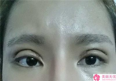 做双眼皮老了会怎样