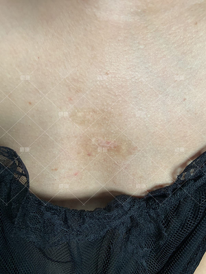 前胸长的痘痘会恢复吗