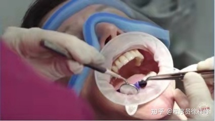 多长时间洗一次牙比较好