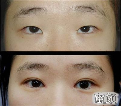 双眼皮的坏处