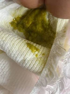 两个月的婴儿拉绿屎是怎么回事