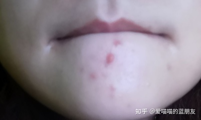 脸上没痘痘有红色痘印