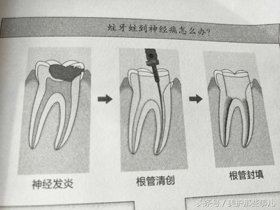 牙疼能自愈吗(如何判断三叉神经痛)