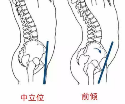 骨盆前倾肚子大