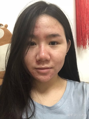 喜欢有痘痘的男生