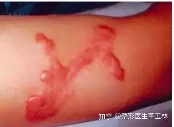 怎么判断自己是疤痕体质