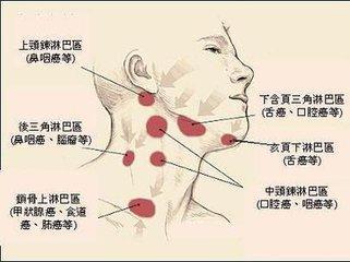 脖子两侧淋巴疼是怎么回事