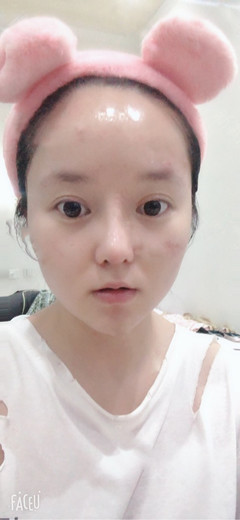 隆鼻之后多久可以吃辣