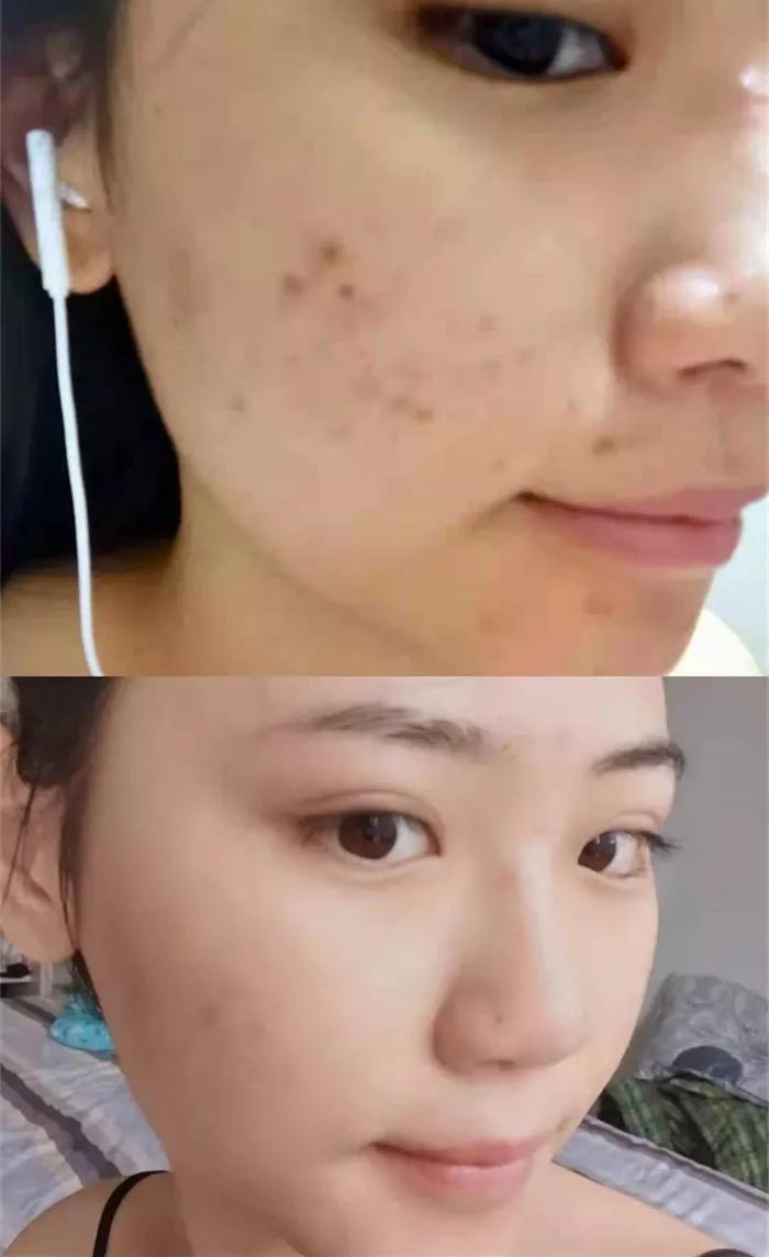 人中痘印怎么消除