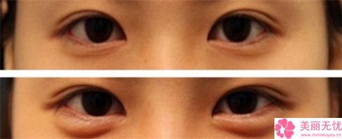 小宝宝卧蚕眼图片