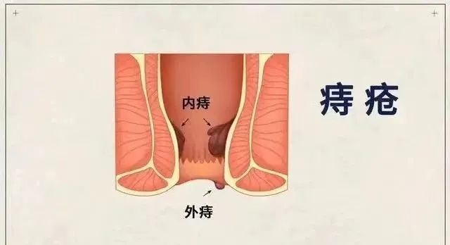 痔漏是怎么回事