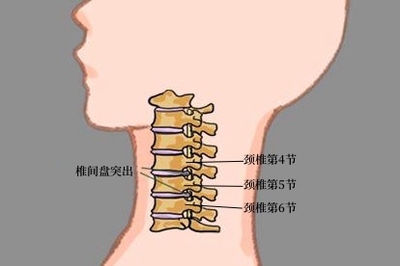 颈椎突出怎么治疗效果好