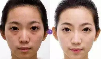 童颜针和水光针的区别
