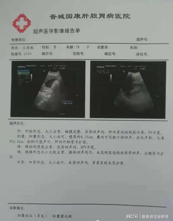胆囊表面粗糙是怎么回事