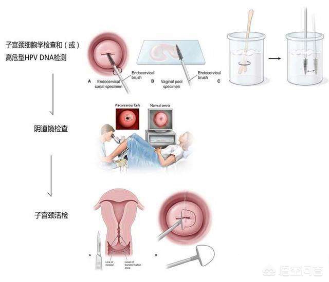 宫颈高危病毒怎么治疗