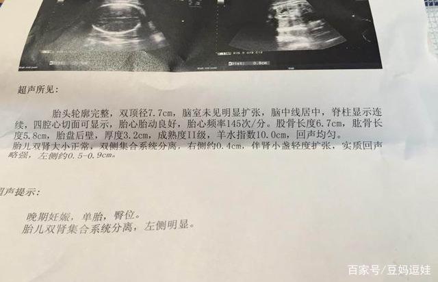 胎儿肾盂扩张是男孩吗
