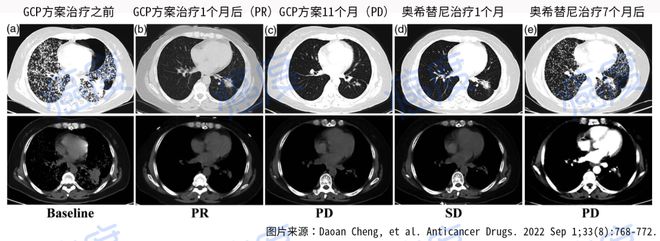 双肺小结节怎么治疗