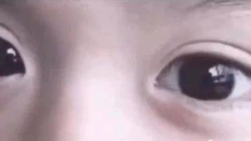 眼睛有白斑是怎么回事