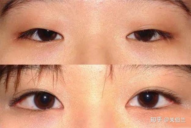 割双眼皮6年后眼皮下垂