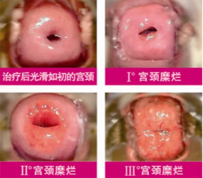 宫颈糜烂两度怎么治疗
