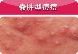 痘痘感染发炎