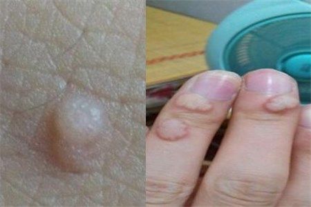 施尔美痘痘怎么消除