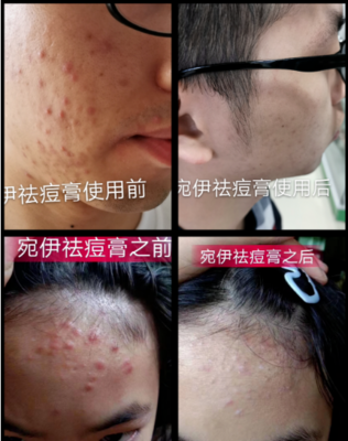 痘痘肌用后的哪个系列
