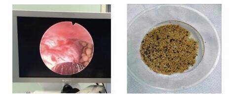 尿结石取石需要多少费用多少钱