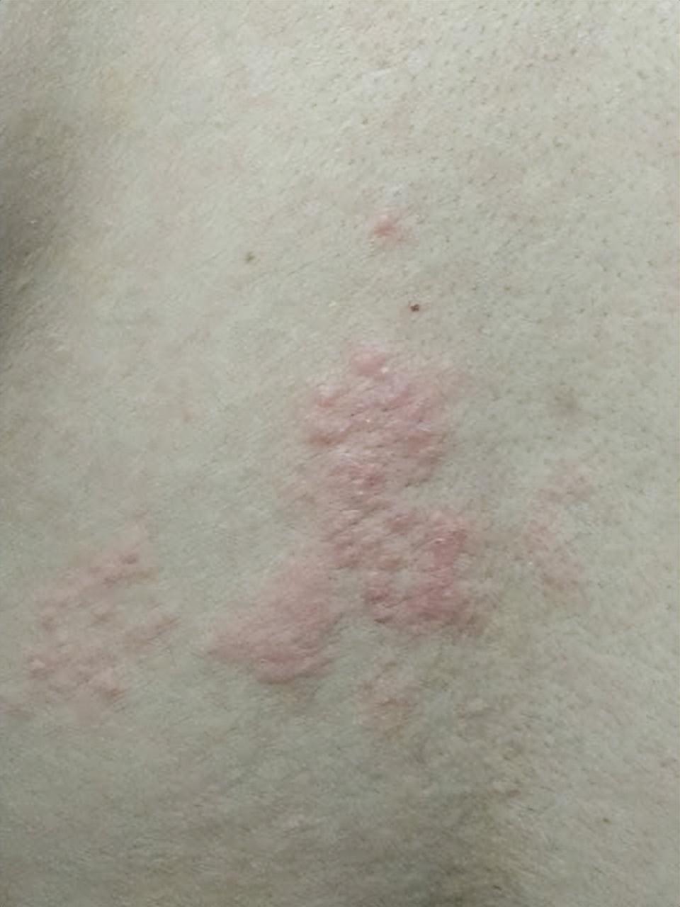 疱疹病毒是什么引起的怎么治疗
