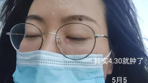 怎样快速催熟痘痘红霉素