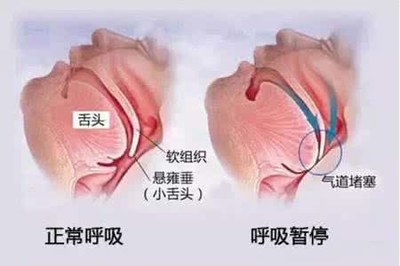怎么治疗扁桃体肥大